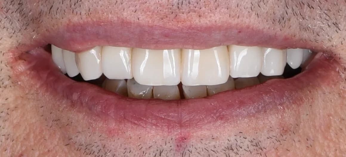 Po léčbě — Náhrada chybějících zubů na implantátech