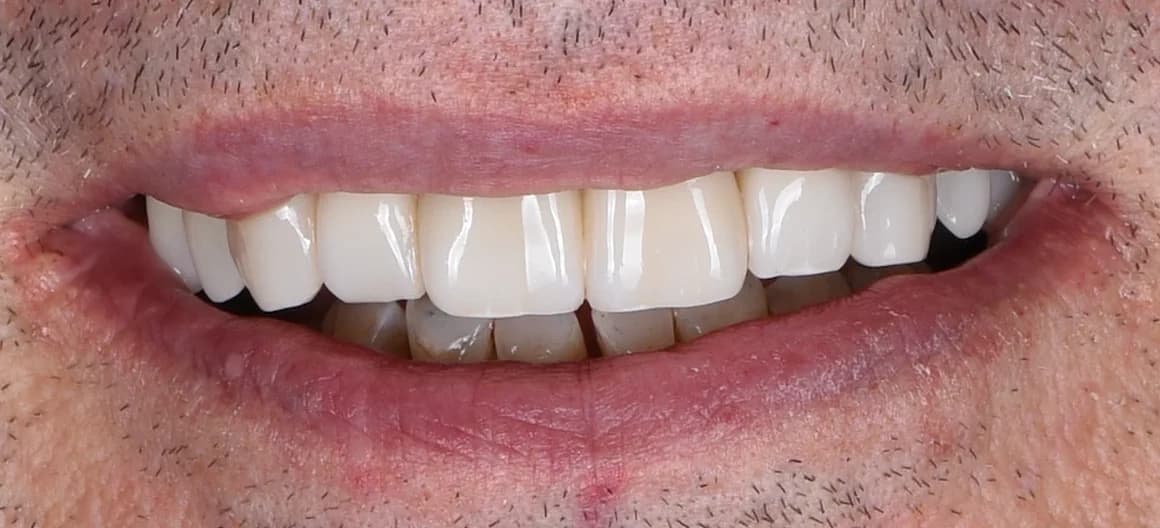 Po léčbě — Náhrada chybějících zubů na implantátech