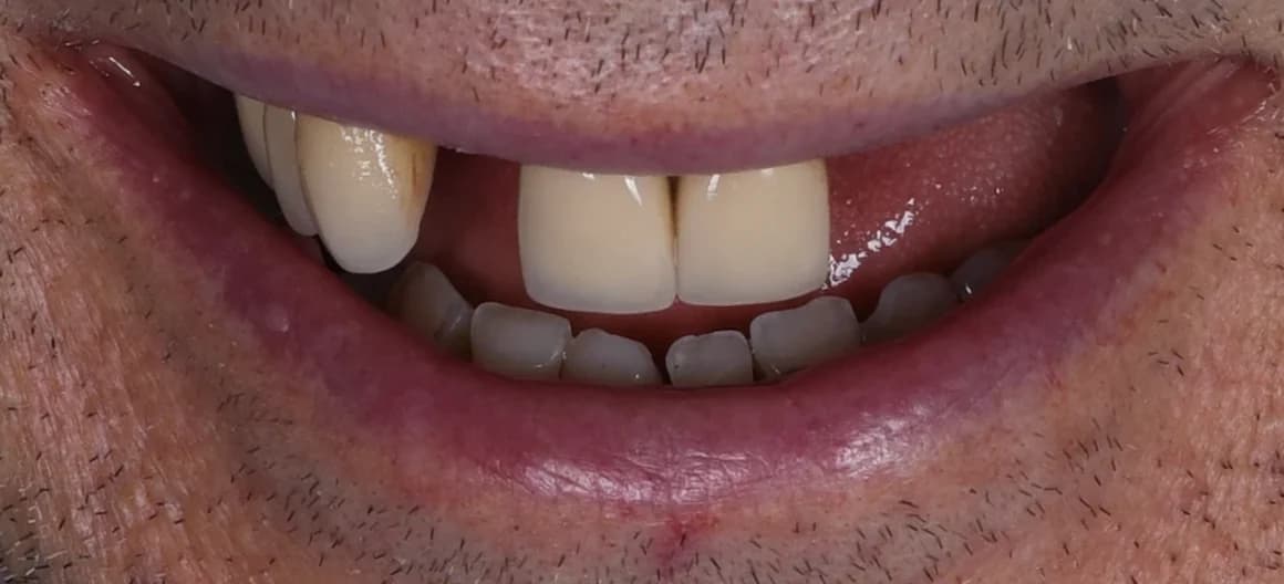 Před léčbou — Náhrada chybějících zubů na implantátech