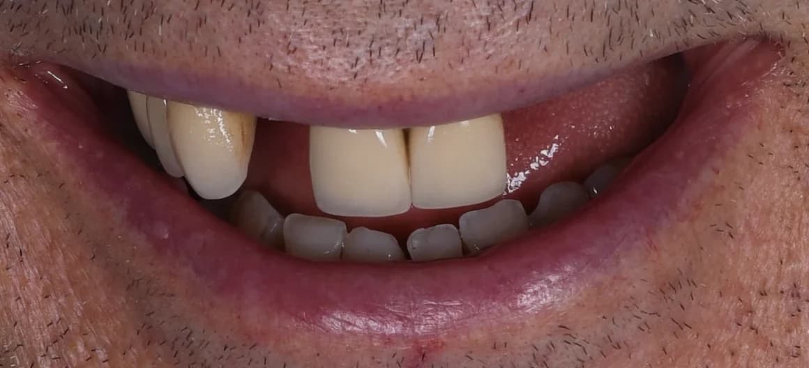 Před léčbou — Náhrada chybějících zubů na implantátech