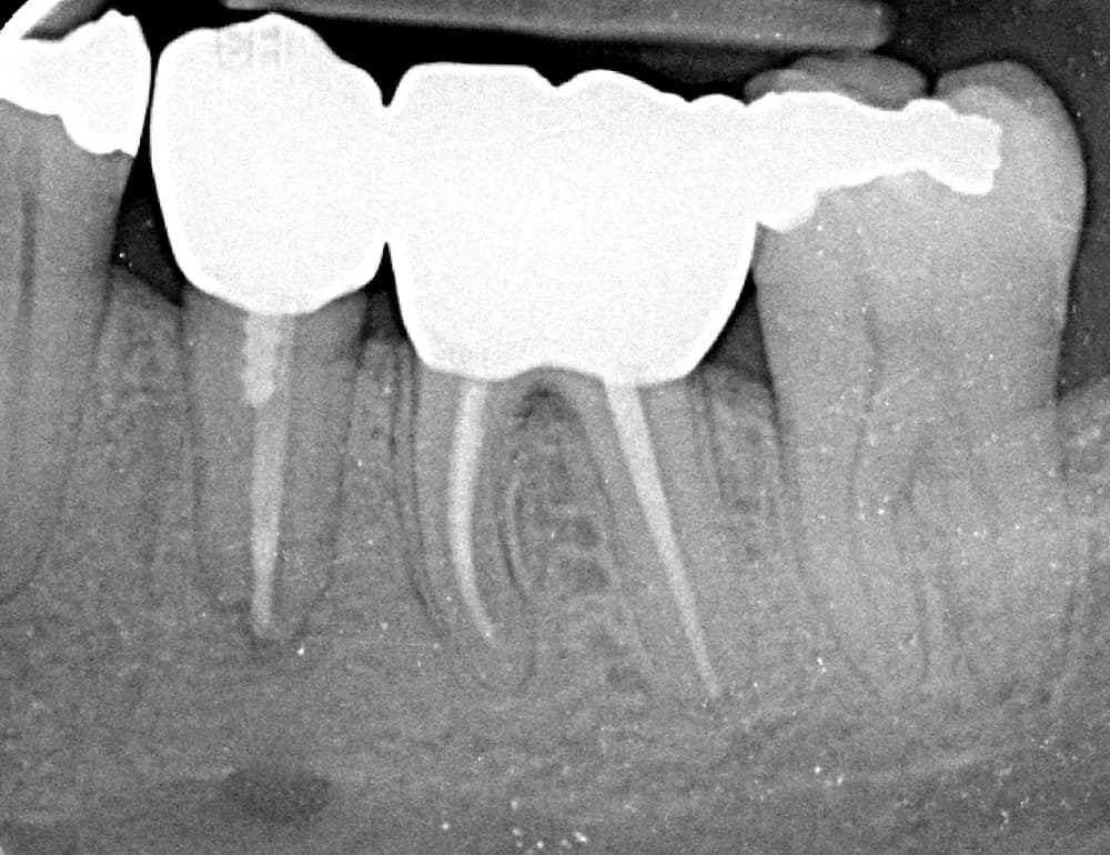 After treatment — Saving teeth with root canal treatment
