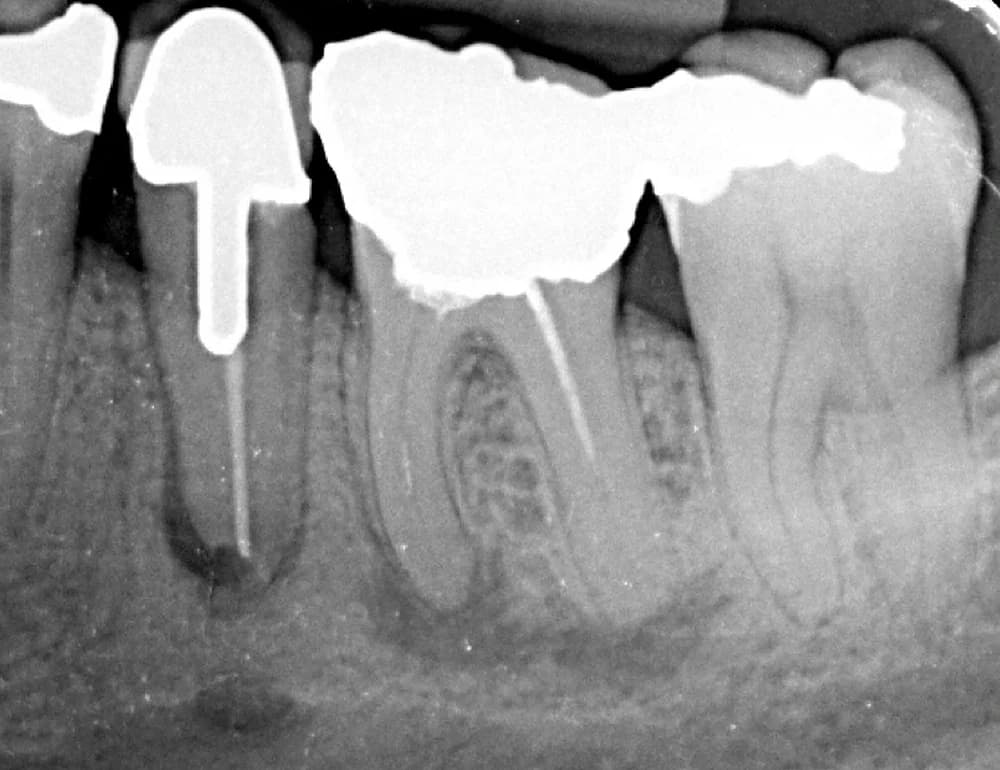 Before treatment — Saving teeth with root canal treatment