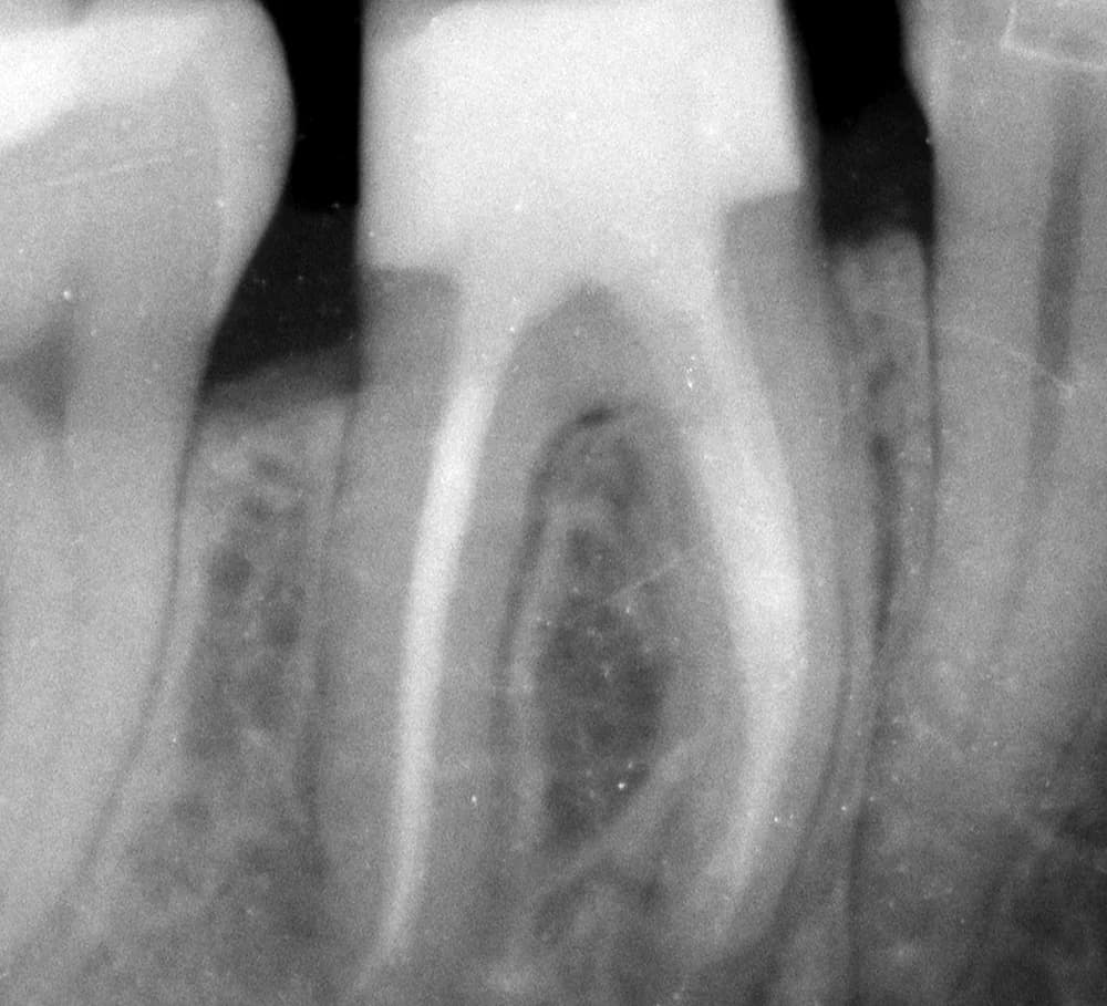 After treatment — Removal of a broken instrument from a root canal