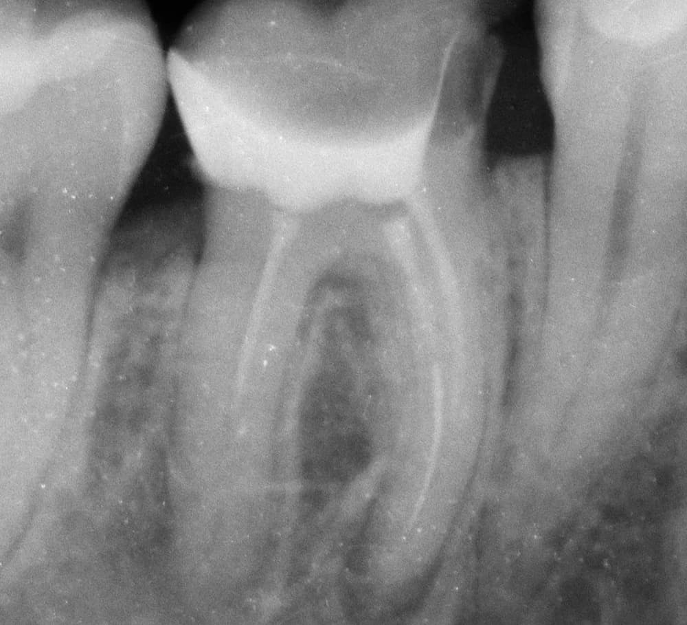 Before treatment — Removal of a broken instrument from a root canal