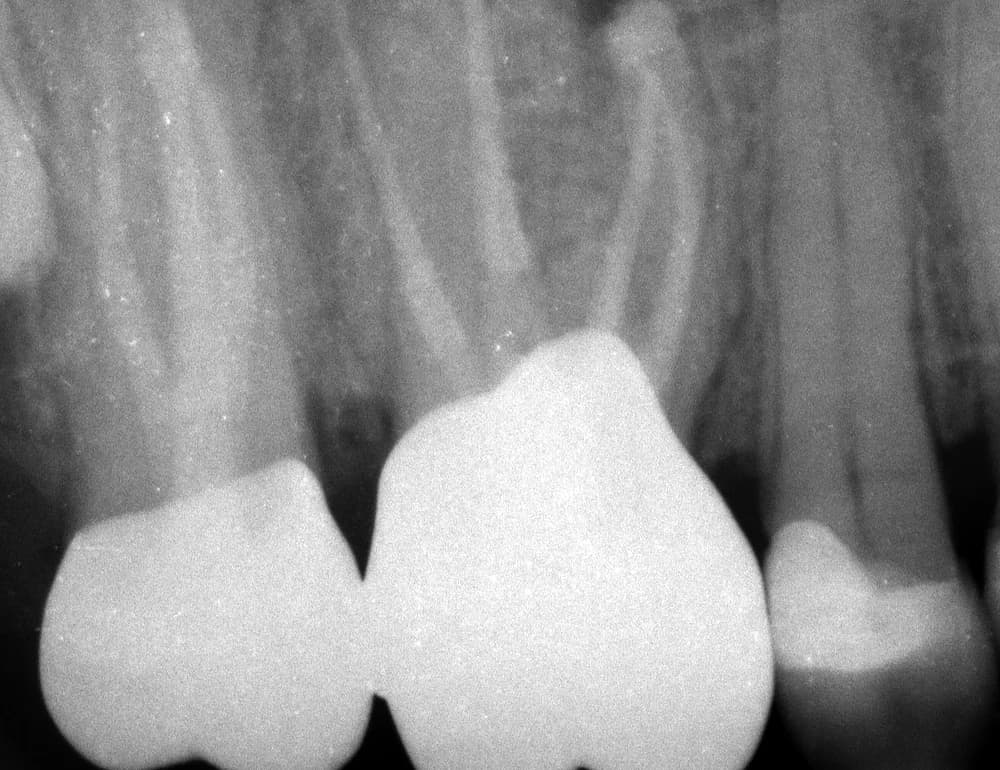 After treatment — Microscopic endodontics and prosthetic reconstruction