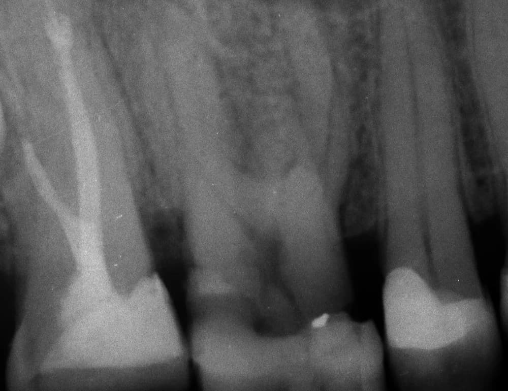 Before treatment — Microscopic endodontics and prosthetic reconstruction
