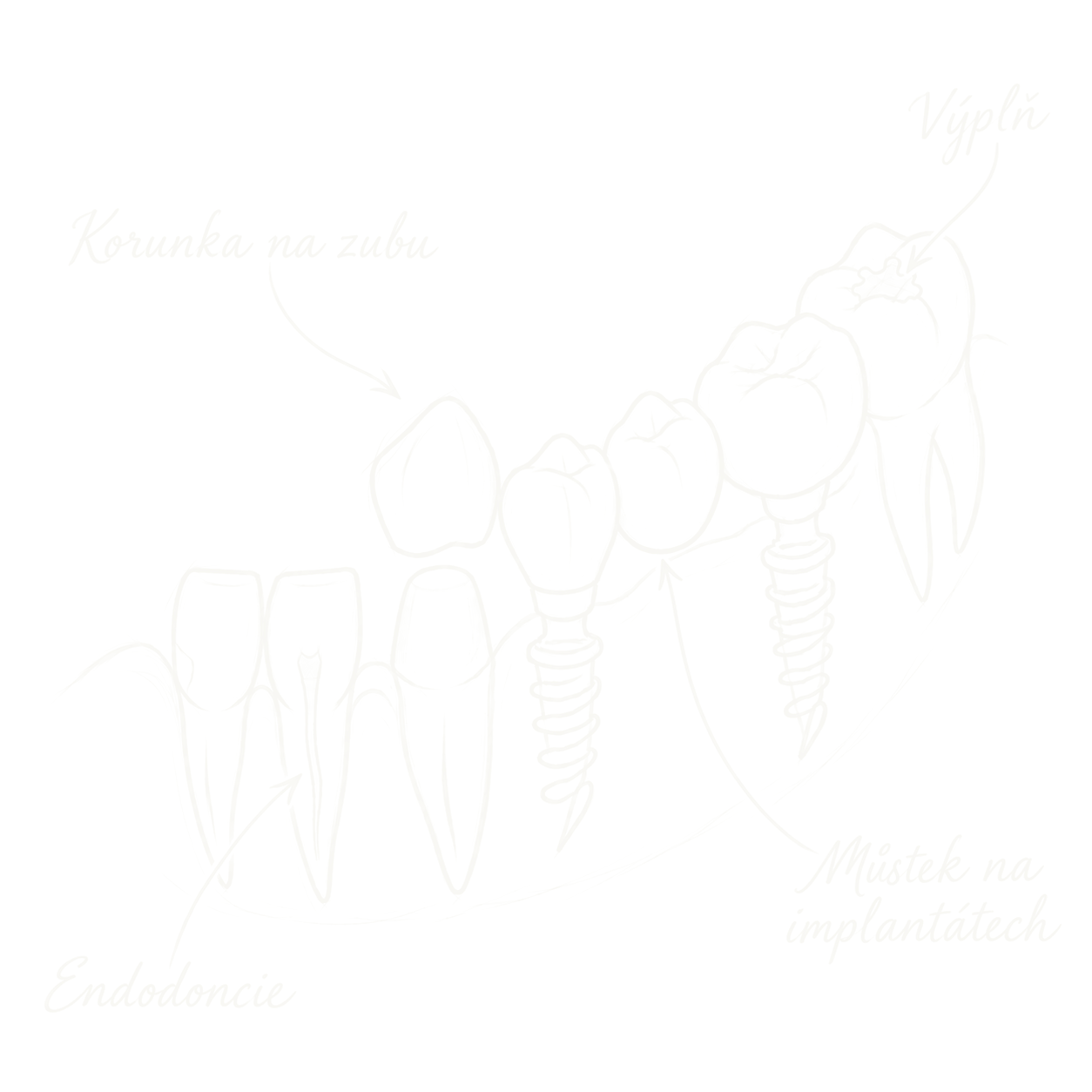 Rekonstrukce chrupu — korunka na zubu, výplň, endodoncie a můstek na implantátech