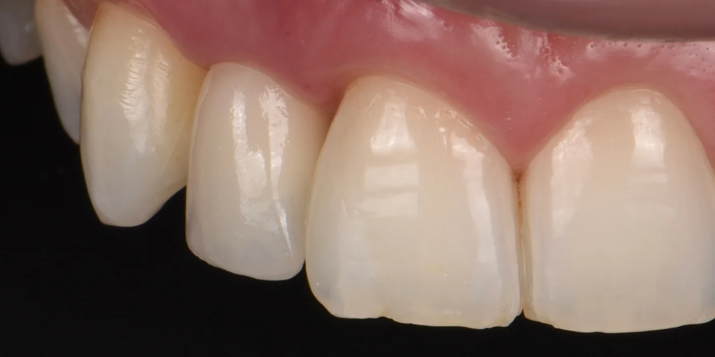 Nach der Behandlung — Weichgewebeaugmentation — Bindegewebstransplantat