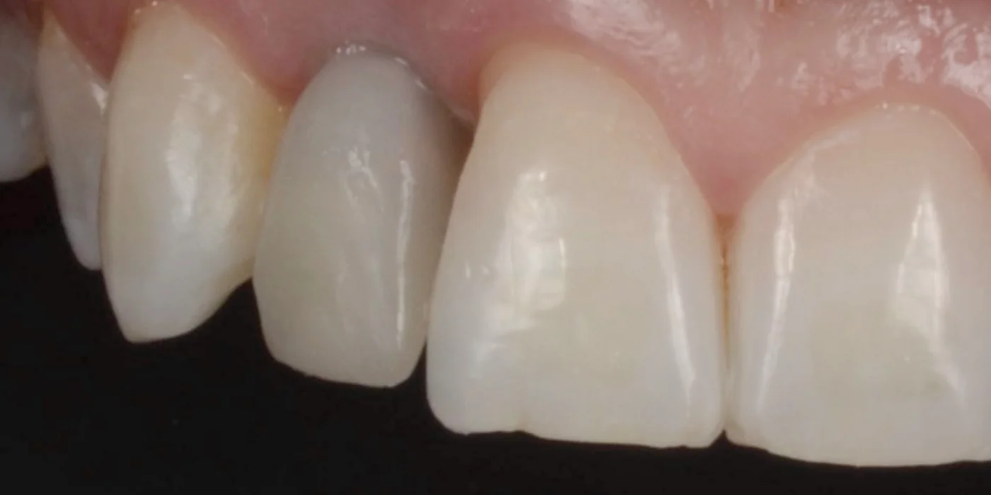 Vor der Behandlung — Weichgewebeaugmentation — Bindegewebstransplantat