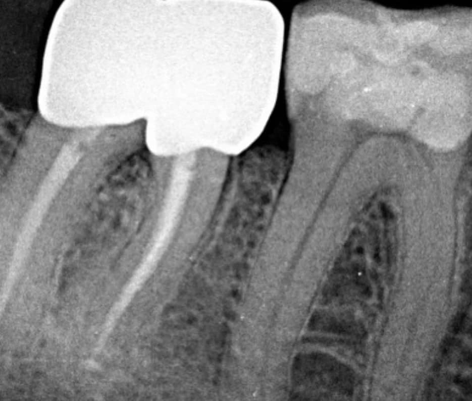 Nach der Behandlung — Abgebrochenes Instrument in einem überkronten Zahn