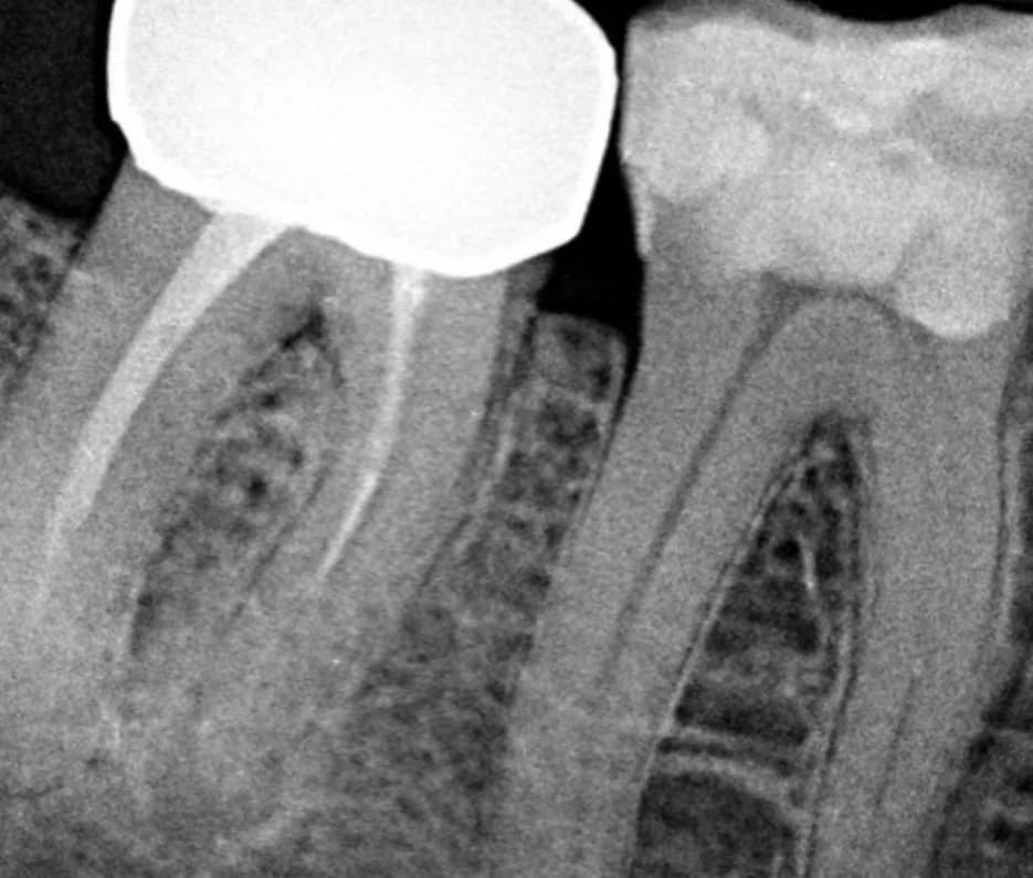 Vor der Behandlung — Abgebrochenes Instrument in einem überkronten Zahn