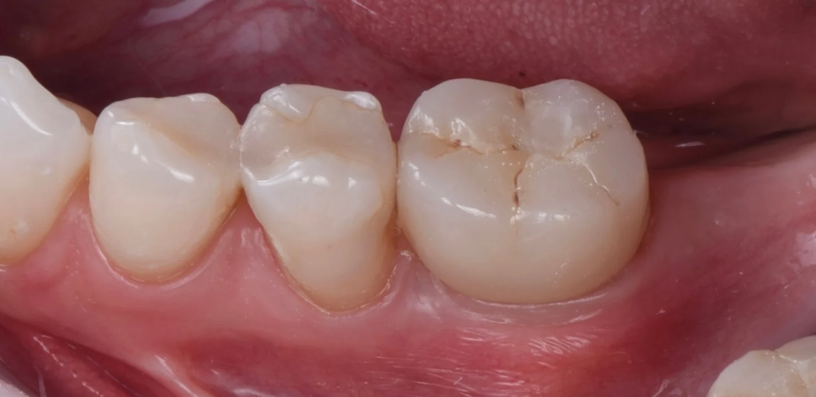 Nach der Behandlung — Implantat mit Bindegewebstransplantat