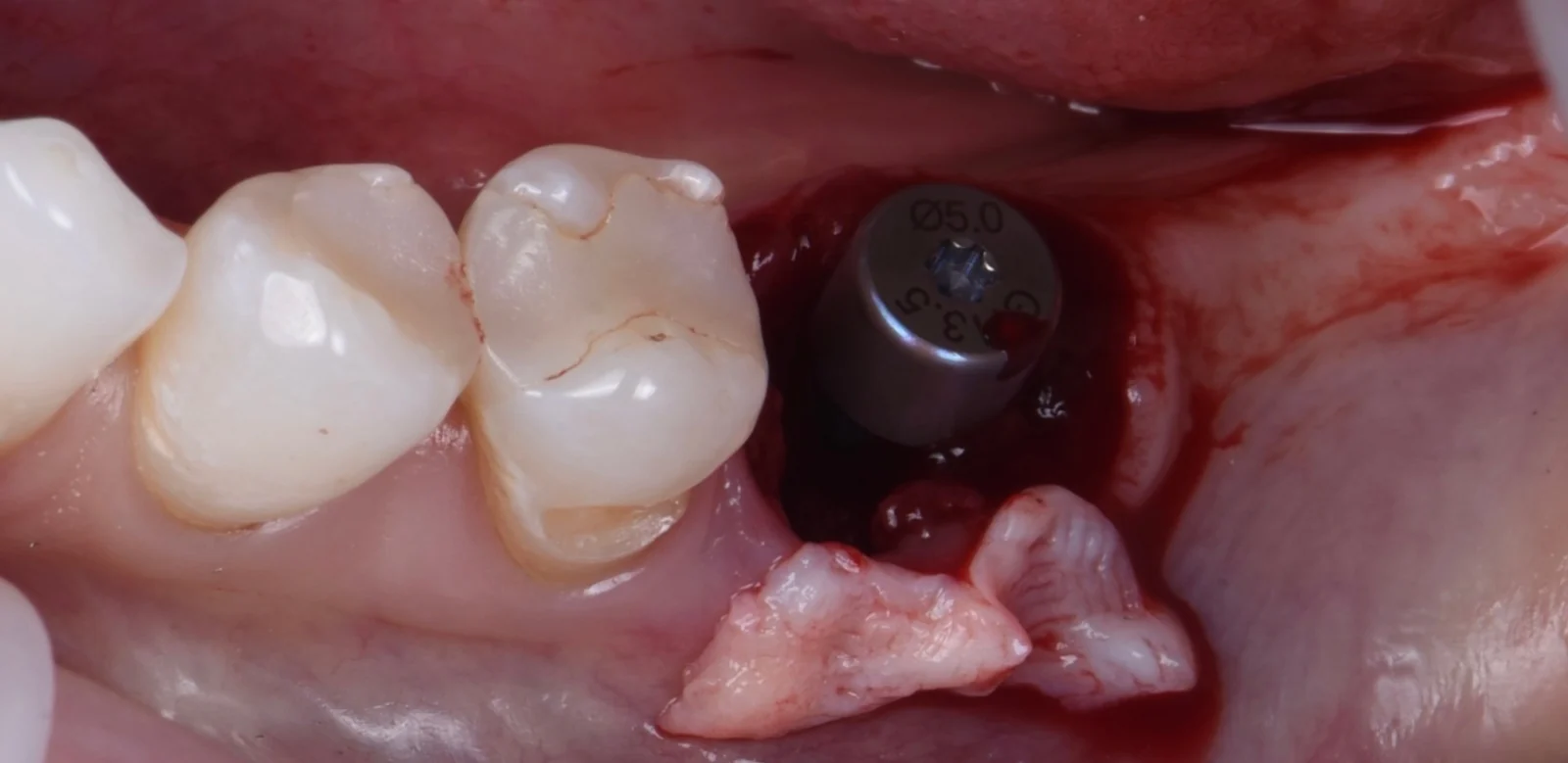 Vor der Behandlung — Implantat mit Bindegewebstransplantat