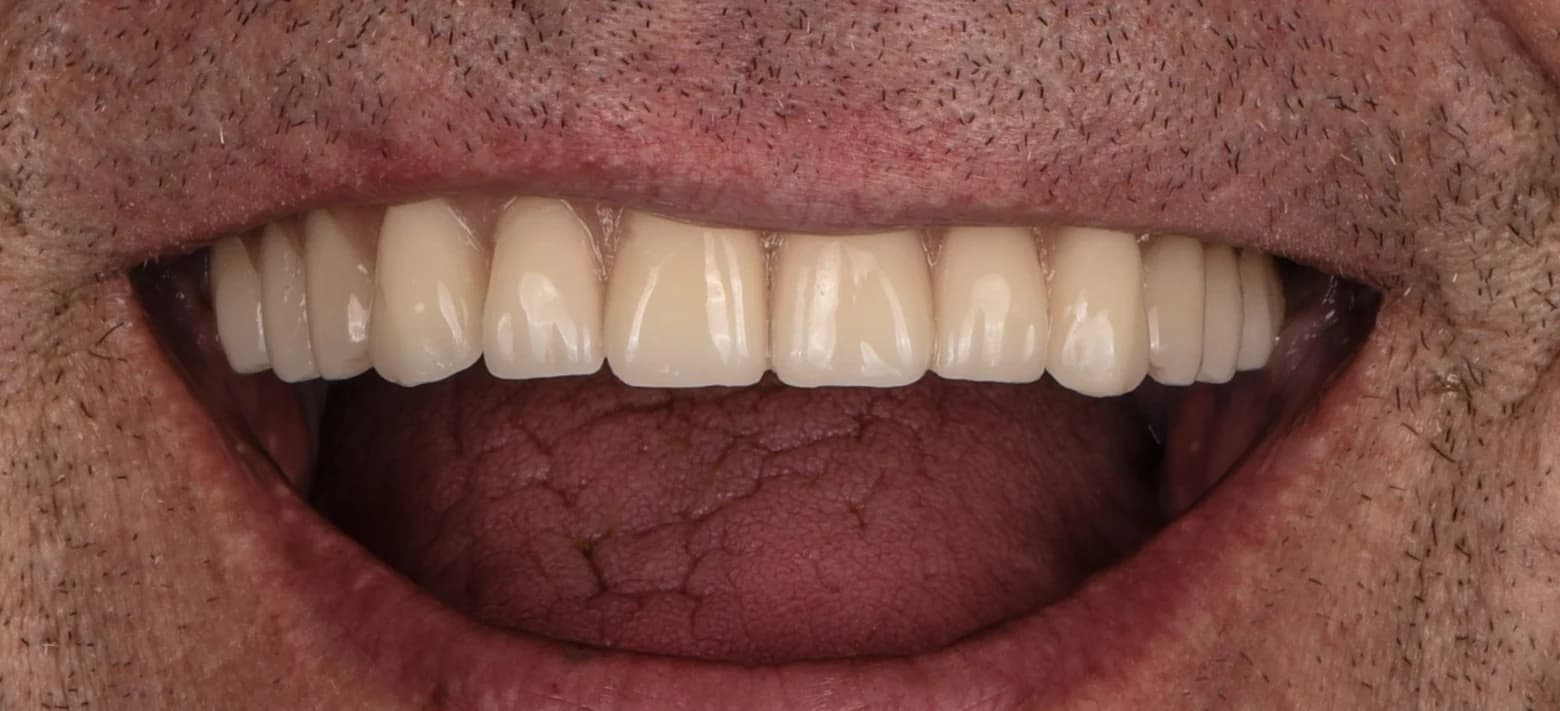Nach der Behandlung — Implantatgetragene Rekonstruktion des Oberkiefers