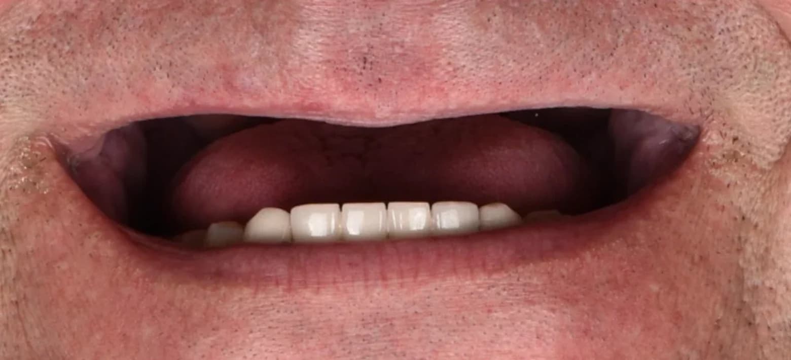 Vor der Behandlung — Implantatgetragene Rekonstruktion des Oberkiefers