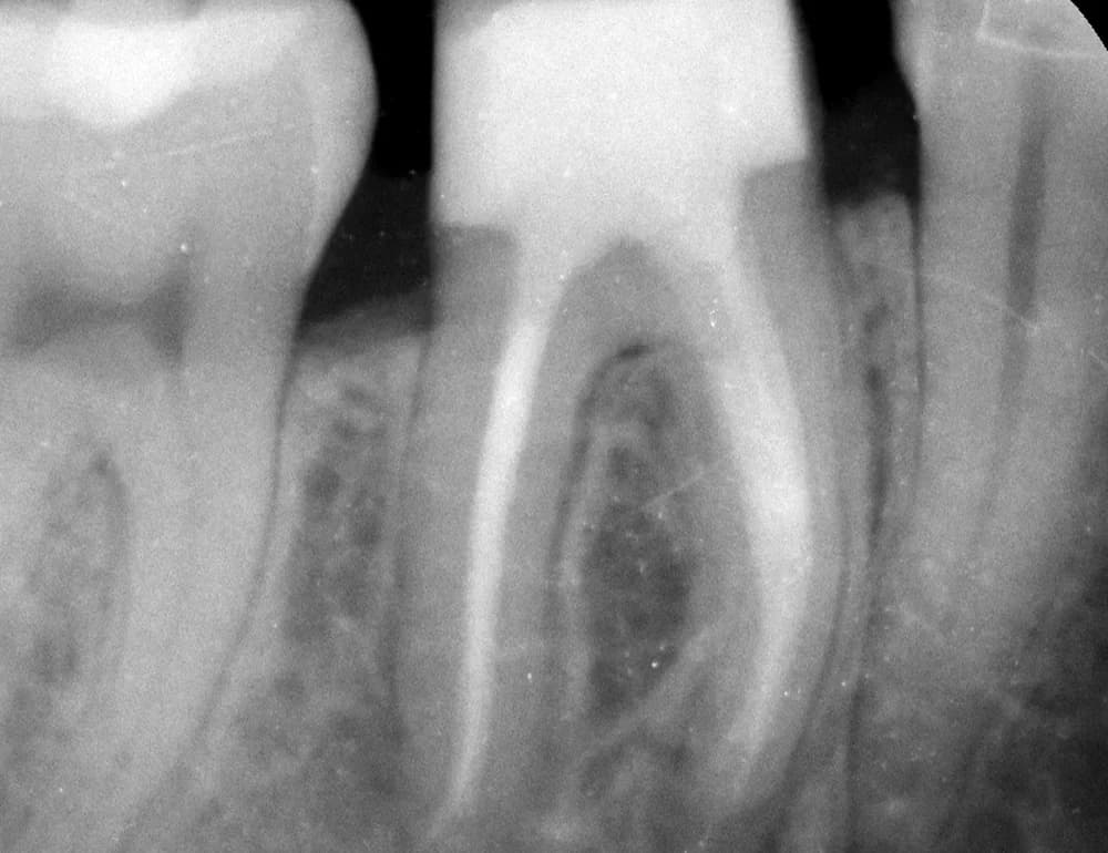 Nach der Behandlung — Entfernung eines abgebrochenen Instruments aus dem Wurzelkanal