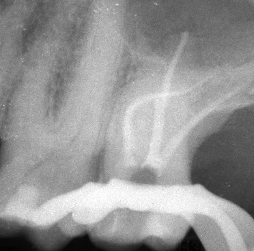 X-ray of an upper molar with filled, strongly curved root canals after treatment under the microscope